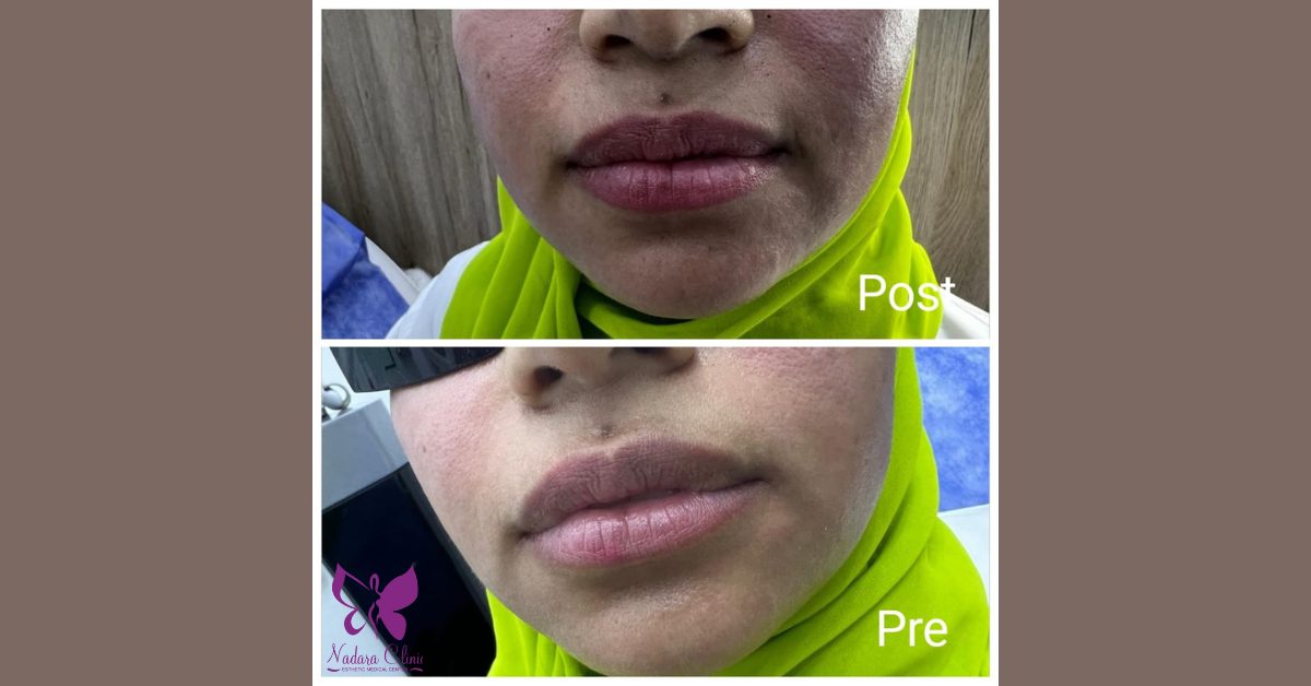 lips pinking laser in Hurghada